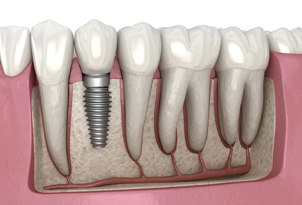 Dental Procedure